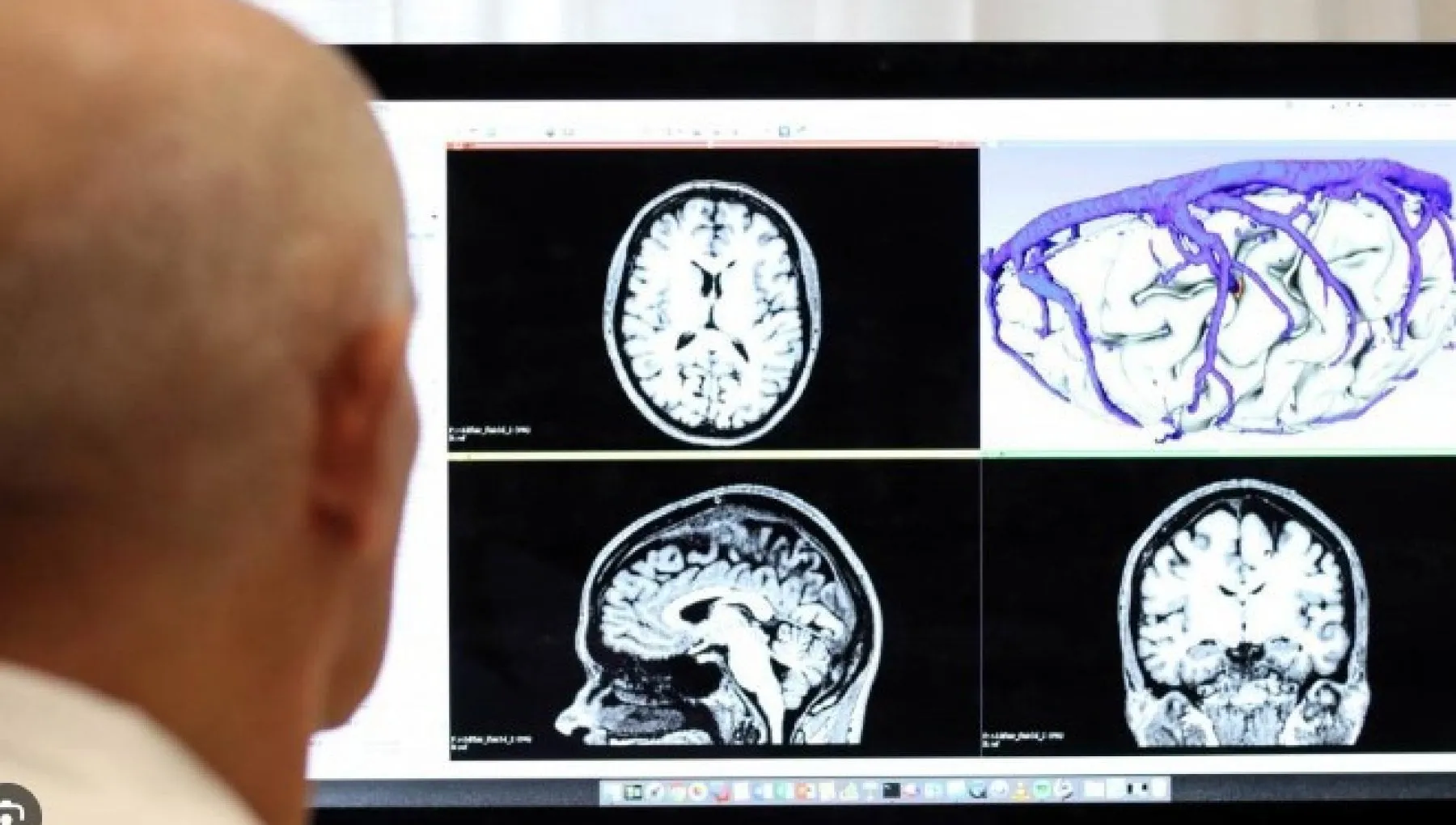 La scoperta che cambia la ricerca sul Parkinson: svelato il meccanismo d’innesco della malattia nel cervello umano