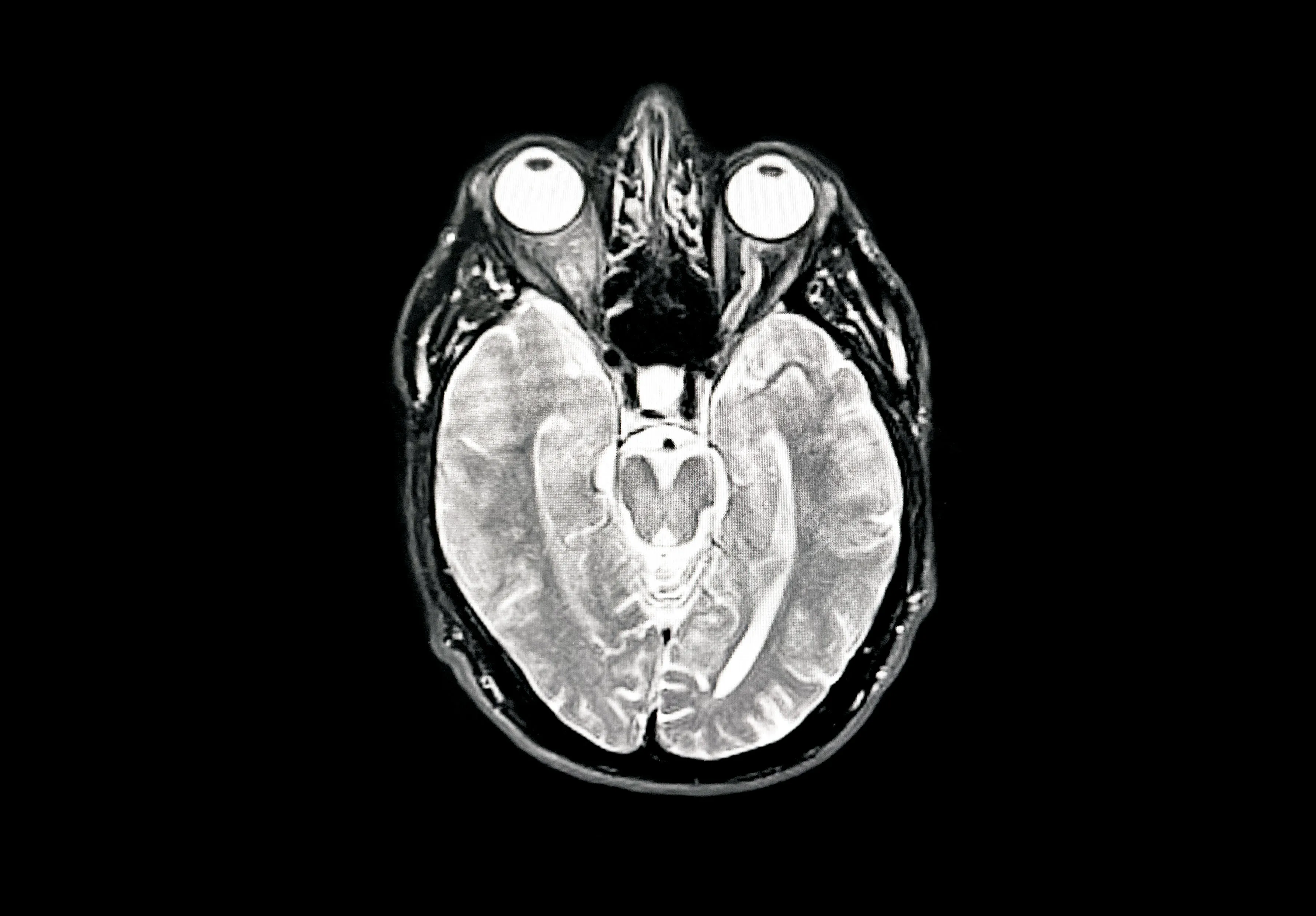Scoperto il circuito neurale della temperatura dal corpo al cervello