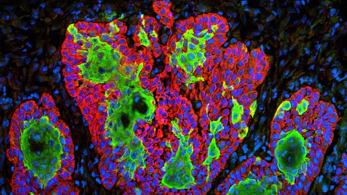 Tumori: Origini Genetiche Ricostruite grazie a 'Resolve', il Nuovo Metodo Italiano