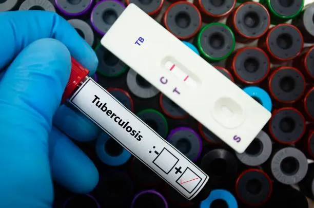 Al liceo di Trieste 30 positivi alla TB, ma metà non si è testata