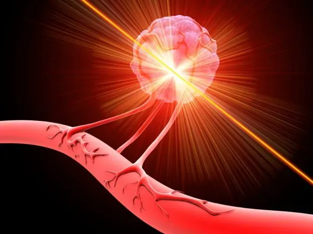 Etichette Laser e Intelligenza Artificiale: La Nuova Frontiera della Diagnosi Precoce dei Tumori