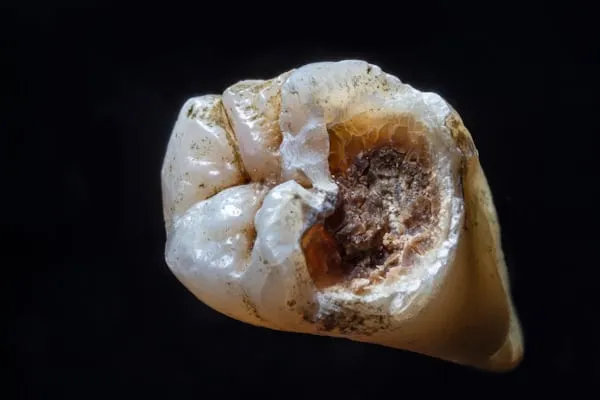 Cura dentale Neanderthal: il record supera Homo sapiens di 40.000 anni