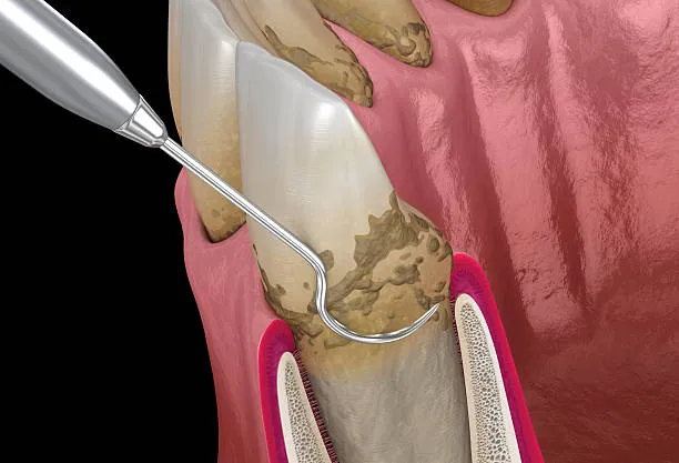 Il tartaro antico svela i segreti della medicina preistorica: il Progetto PreMED alla guida della ricerca europea
