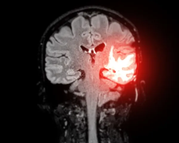 Intelligenza Artificiale e Ictus Acuto: RapidAI Rivoluziona la Diagnosi alla ASL di Teramo