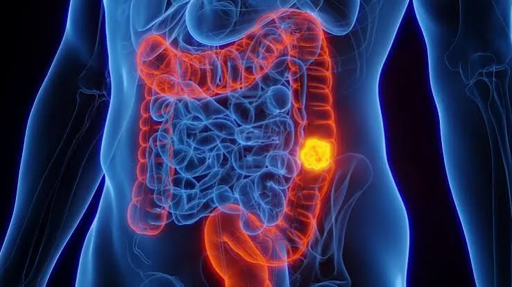 Ndrg1 come nuovo Brca: verso terapie mirate per il tumore del colon