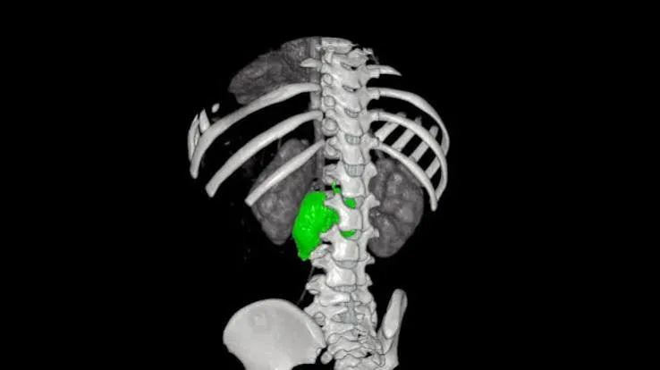 Neuroblastoma con simulazione 3D: il caso del Bambino Gesù nei numeri