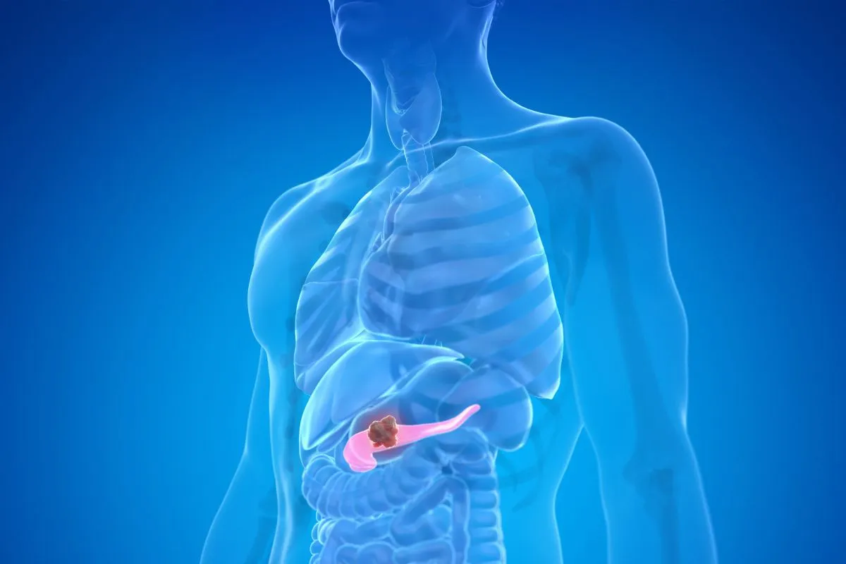 Scoperta la firma genetica chiave del cancro al pancreas