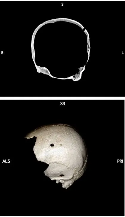 Un cranio con quattro trapanazioni riuscite: il paziente medievale